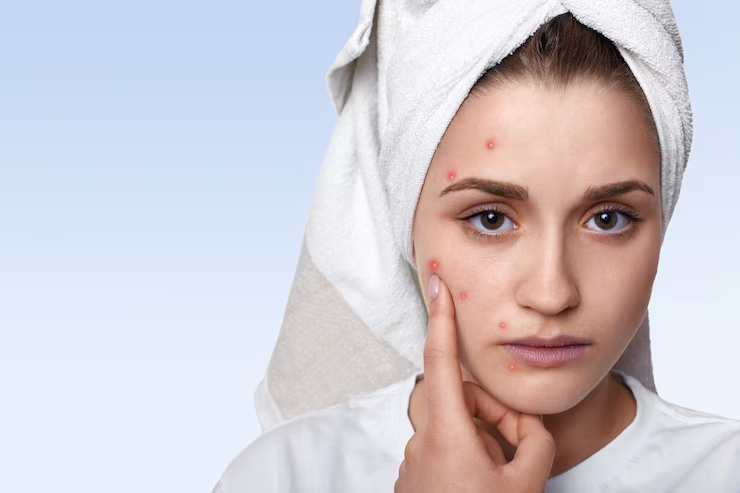 10 Useful Remedies to Remove Acne Scars Naturally: A Complete Guide